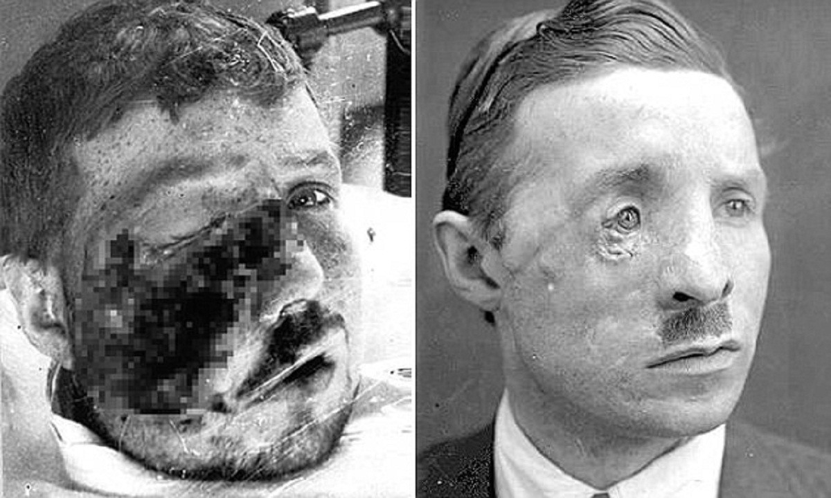 Солдаты Первой мировой - пациенты первых пластических хирургов (17 фото)
