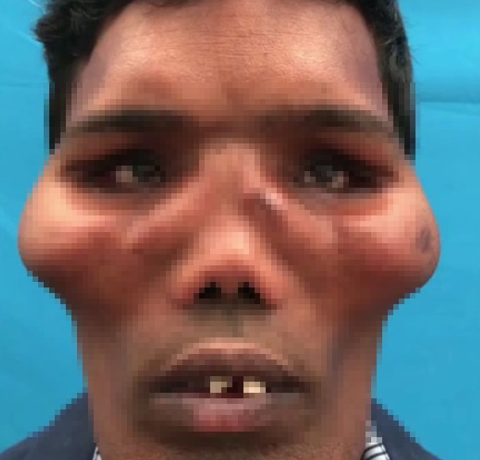 Хирурги перекроили внешность мужчины с синдромом львиного лица (4 фото)